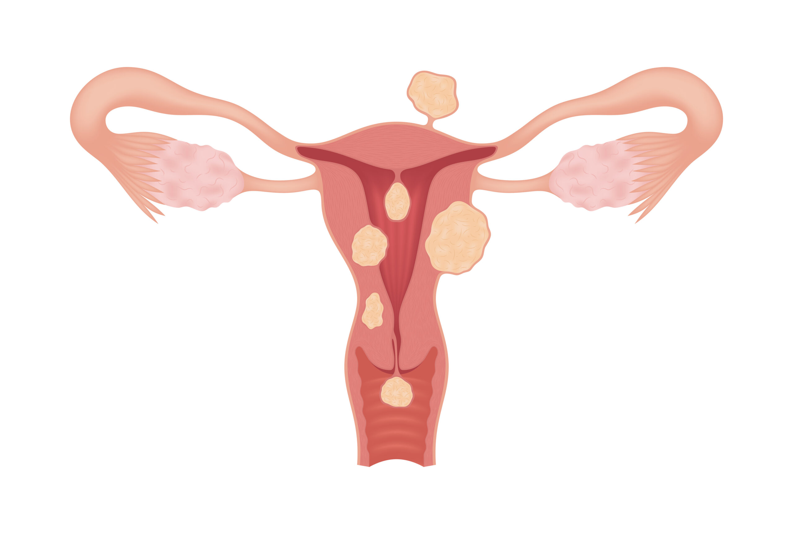 Sick female reproductive system with various types of myomas isolated on whte background. Realistic drawing showing the internal organs. Frontal view in a cut.